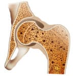 Osteoporose
